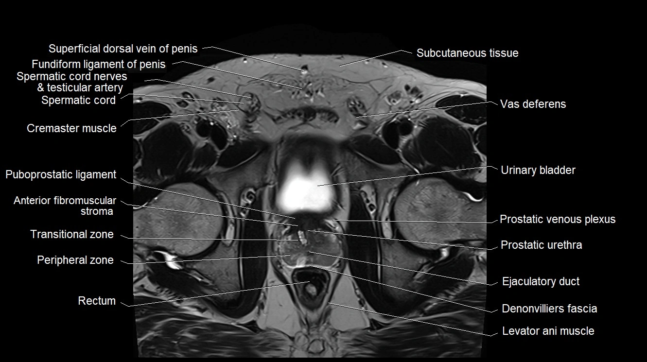 MRI 3T scrotum and penis axial cross sectional anatomy image 7.webp
